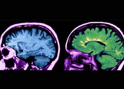 ابداع روشی خطرناک برای درمان ام اس