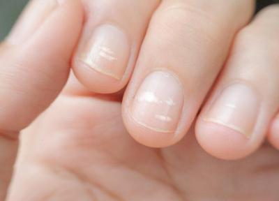 نکته بهداشتی، ناهنجاری های ناخن